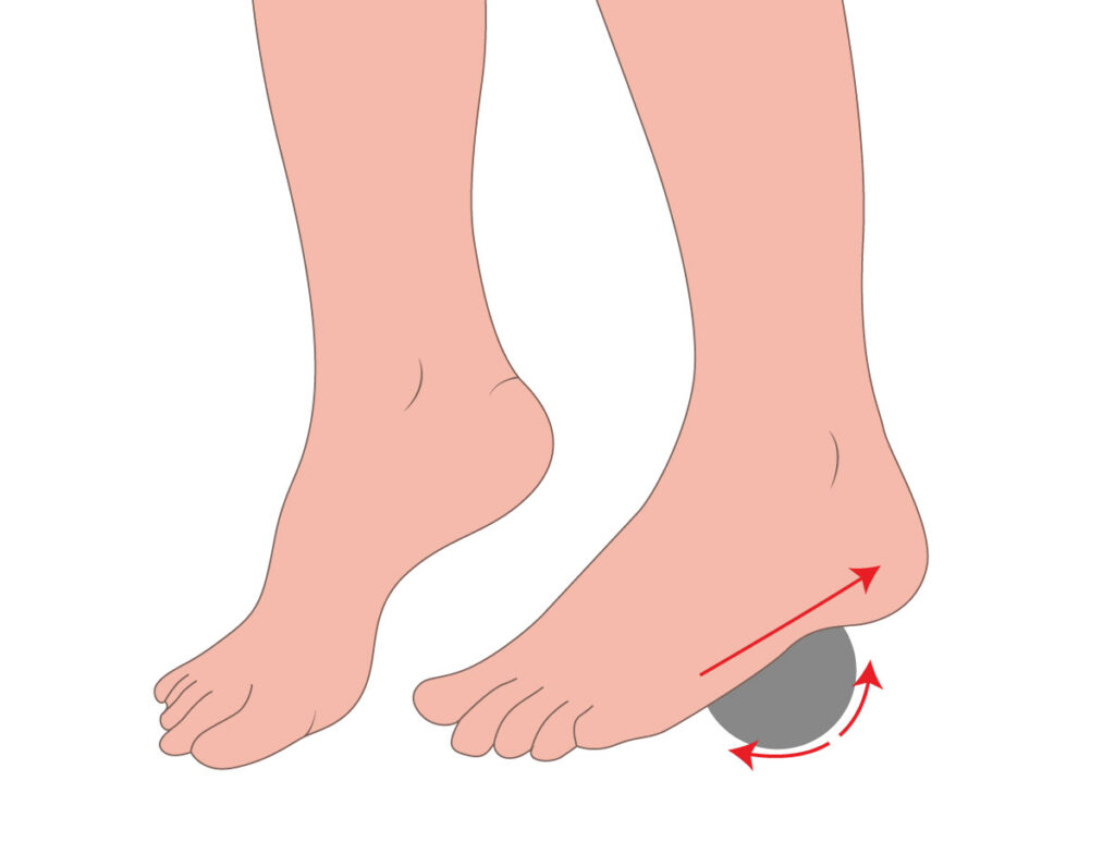 How to Treat Plantar Fasciitis for Runners
